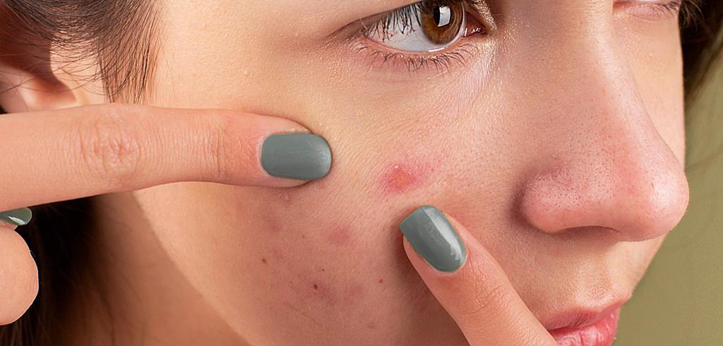 Acne marks treatment in ibiza