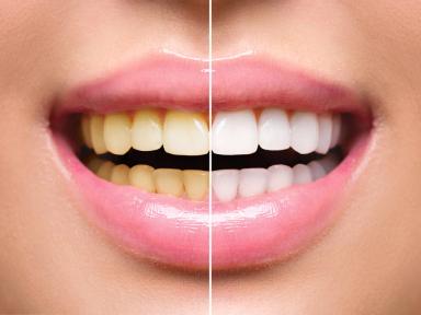 How To Whiten Your Teeth Without Hurting Them